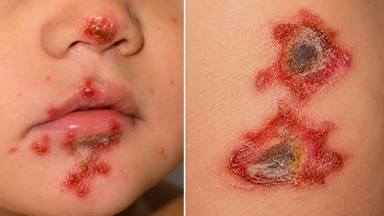 Chốc lây là gì? Nguyên nhân, dấu hiệu, cách điều trị và phòng ngừa