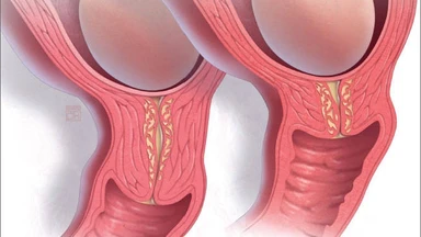 Cổ tử cung bao nhiêu là ngắn? Nguy cơ và cách điều trị