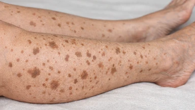 Da chân bị đốm nâu: Nguyên nhân, dấu hiệu và cách chăm sóc giúp cải thiện an toàn