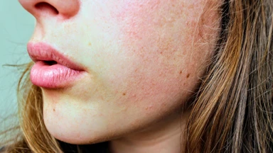 Da mặt bị dị ứng ngứa phải làm sao để nhanh dịu da?