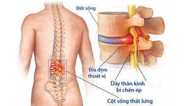 Đau dây thần kinh liên sườn gây khó thở: Nguyên nhân, dấu hiệu và hướng xử trí