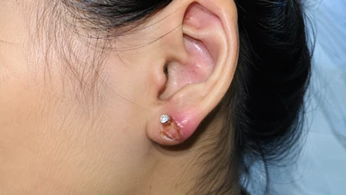 Dấu hiệu bấm lỗ tai bị nhiễm trùng là gì và cách xử lý đúng?