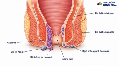 Dấu hiệu bị trĩ khi mang thai và cách xử trí an toàn cho mẹ bầu