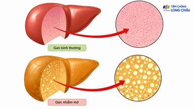 Dấu hiệu gan nhiễm mỡ: Nhận biết sớm để bảo vệ lá gan