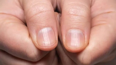 Dấu hiệu móng tay bị bệnh cảnh báo vấn đề sức khỏe cần lưu ý 
