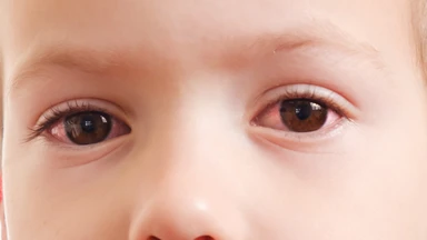 Dấu hiệu trẻ bị đau mắt đỏ kèm sốt cao và cách chăm sóc tại nhà bố mẹ cần biết