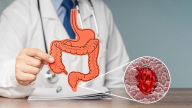 Dấu hiệu ung thư hậu môn giai đoạn đầu: Nhận biết sớm để điều trị kịp thời