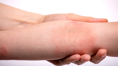 Dấu hiệu viêm da cơ địa thường gặp và những điều cần lưu ý