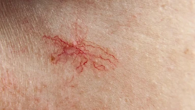 Dấu sao mạch: Nguyên nhân, dấu hiệu và cảnh báo bệnh lý tiềm ẩn
