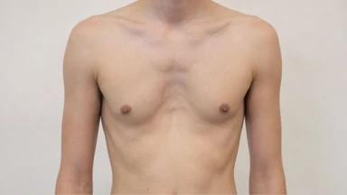 Dị dạng lồng ngực: Các dạng thường gặp và dấu hiệu nhận biết 