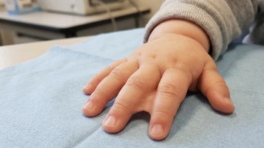 Dị tật dính ngón tay là gì? Nguyên nhân và các dạng dính ngón tay thường gặp