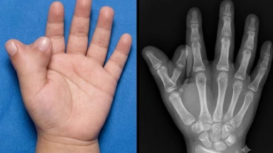 Dị tật thừa ngón tay cái: Nguyên nhân và cách điều trị hiệu quả