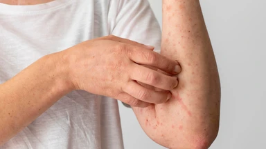 Dị ứng hạt mè: Triệu chứng nhận biết, cách xử trí và phòng ngừa