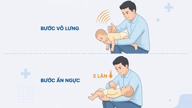 Dị vật đường thở ở trẻ em: Dấu hiệu nhận biết và cách xử trí đúng