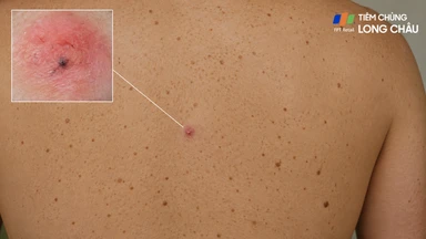 Đốm đỏ ung thư máu: Dấu hiệu nhận biết và cách xử trí