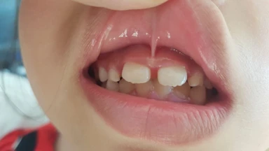 Đứt thắng môi trên ở trẻ là gì? Cách sơ cứu và chăm sóc an toàn