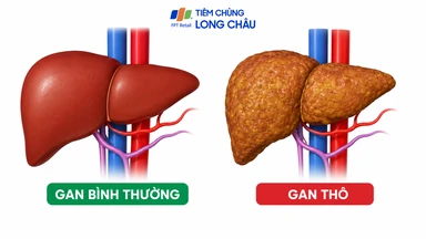 Gan thô có phải xơ gan không? Cần làm gì khi có kết quả siêu âm gan thô? 