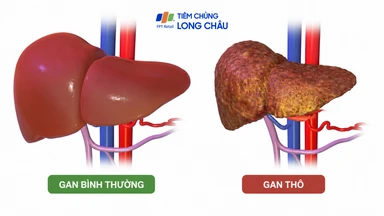 Gan thô nhẹ có phục hồi được không?