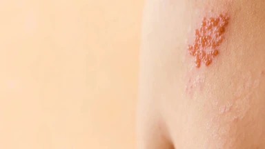 Ghẻ phỏng là gì? Nguyên nhân, triệu chứng và phòng ngừa hiệu quả