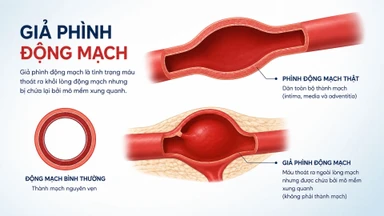 Giả phình động mạch là gì? Nguyên nhân, dấu hiệu và cách điều trị