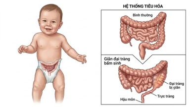 Giãn đại tràng bẩm sinh là gì? Dấu hiệu, nguyên nhân và cách điều trị