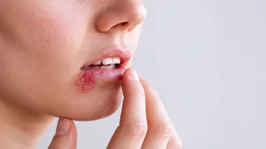 herpes_co_lay_qua_hon_khong_cach_nhan_biet_va_phong_ngua_lay_nhiem_1_28c063f7c0