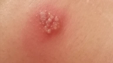 Herpes simplex virus type 1 và type 2: Nhận diện và kiểm soát hiệu quả
