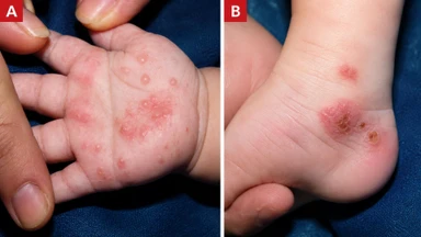 Hình ảnh bệnh ghẻ ở trẻ em: Đặc điểm nhận biết và dấu hiệu cần đi khám