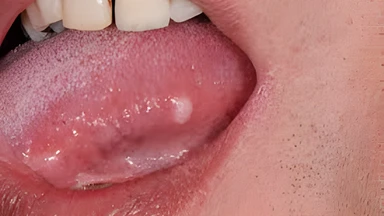 Hình ảnh ung thư lưỡi qua từng giai đoạn có đặc điểm gì?
