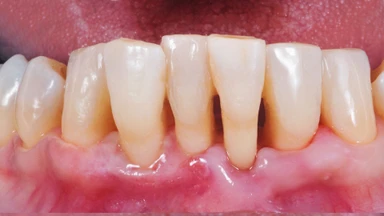 Hở chân răng là gì? Những điều cần biết về hở chân răng