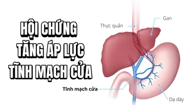 Hội chứng tăng áp lực tĩnh mạch cửa: Nguyên nhân, triệu chứng và điều trị