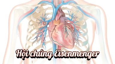 Hội chứng Eisenmenger: Nguyên nhân, triệu chứng và điều trị
