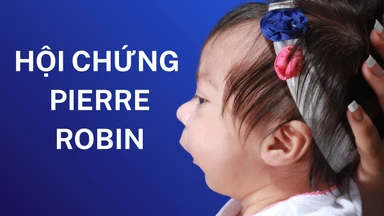 Hội chứng Pierre Robin: Nguyên nhân, triệu chứng và điều trị