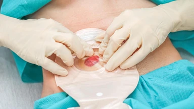 Khi nào đóng hậu môn nhân tạo? Điều kiện và những lưu ý cần biết