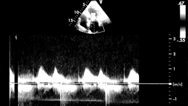 Khối echo là gì? Phân loại khối echo