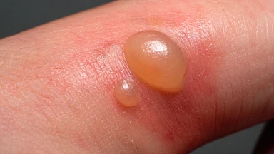 Kiến cắn nổi mụn nước có nguy hiểm không? Cách xử trí an toàn