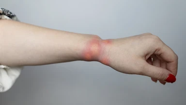 Kiến cắn sưng to: Nguyên nhân, triệu chứng và cách xử lý an toàn
