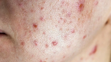 Làm sao để hết mụn tuổi dậy thì? Cách chăm sóc da phù hợp