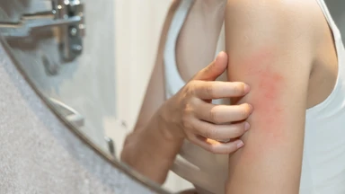 Top 5 bước xử lý sơ cứu dị ứng thức ăn và mẹo giảm ngứa nhanh chóng