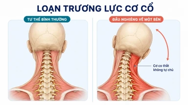 Loạn trương lực cơ cổ là gì? Triệu chứng, nguyên nhân và cách điều trị