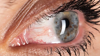 Lòng trắng mắt có nhiều tia máu đỏ: Nguyên nhân và cách xử lý