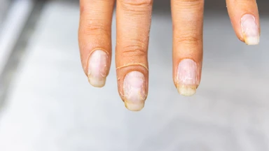 Móng tay bị sần sùi thiếu chất gì? Dưỡng chất quan trọng và cách cải thiện