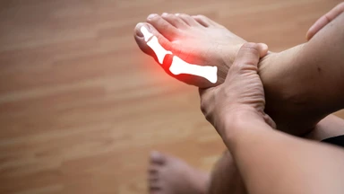 Một số cách phòng bệnh gout mà bạn có thể tham khảo