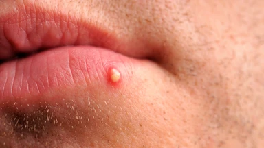 Mụn mọc quanh miệng: Dấu hiệu và cách phòng ngừa mụn tái phát