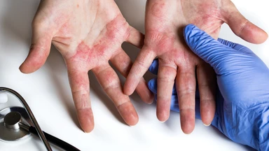 Mụn nước ở tay: Dấu hiệu nhận biết và cách phòng ngừa hiệu quả