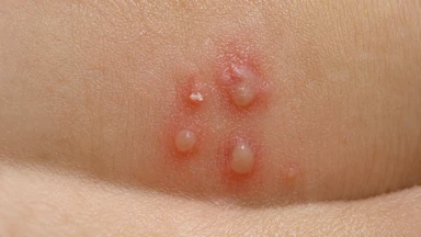 Mụn rộp sinh dục giai đoạn đầu: Dấu hiệu dễ nhận biết