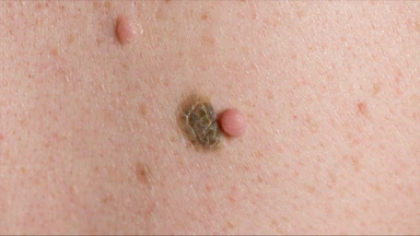 Mụn thịt là gì? Triệu chứng, nguyên nhân, chẩn đoán và điều trị