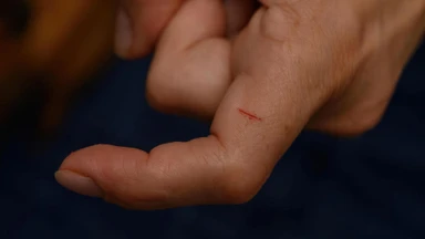 Ngoài da chỉ xước nhẹ có bị uốn ván không?