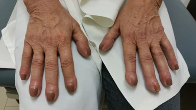 Ngón tay dùi trống là gì? Dấu hiệu cảnh báo nhiều vấn đề sức khỏe không nên bỏ qua