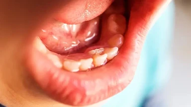 Người có 36 cái răng thì sao? Phải làm gì khi có 36 răng?